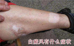 面對(duì)身上的白斑如何檢查確診