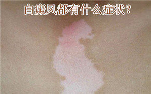 從哪些癥狀來(lái)看你的白癜風(fēng)有無(wú)惡化