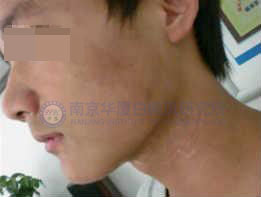 1.3.jpg 孫子罹患白癜風(fēng),,爺爺帶其到華廈治愈