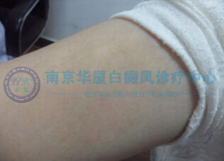 手臂治療后.jpg 手臂大塊白斑,,終在南京華廈康復