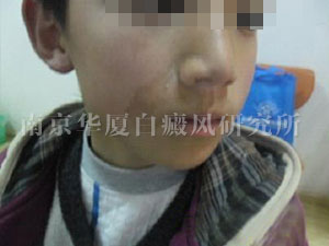 92.jpg 【NO.59990病例】10歲孩子選擇南京華廈治好了唇部白斑