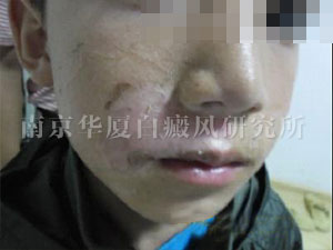 【NO.59990病例】10歲孩子選擇南京華廈治好了唇部白斑 【NO.59990病例】10歲孩子選擇南京華廈治好了唇部白斑