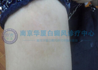 手臂治療中.jpg 手臂大塊白斑,終在南京華廈康復