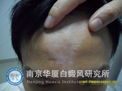 81.jpg 【NO.50789病例】告別白癜風(fēng),,拒做“家庭煮夫”