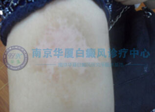 治好白癜風(fēng) 心里的一塊石頭終于落下