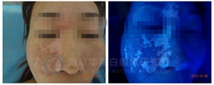 61.jpg 【NO.9321病例】化妝品竟成“毀容品”,滿臉“瘋長”白癜風(fēng)
