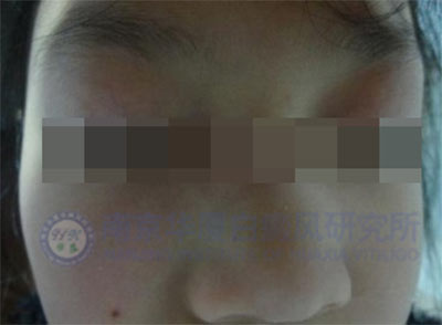 治好白癜風(fēng),,7歲女童重展笑顏