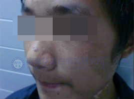 孫子罹患白癜風(fēng),,爺爺帶其到華廈治愈 孫子罹患白癜風(fēng),,爺爺帶其到華廈治愈