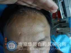 82.jpg 【NO.50789病例】告別白癜風(fēng),,拒做“家庭煮夫”