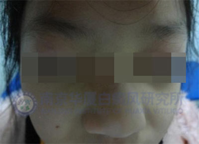 治好白癜風(fēng),7歲女童重展笑顏