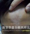 【NO.50789病例】告別白癜風(fēng),，拒做“家庭煮夫”