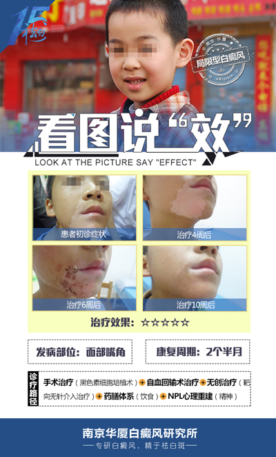 小孩臉上有白斑怎么辦 小孩臉上有白斑怎么辦