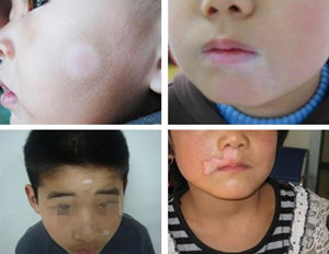 小孩臉上有白斑怎么辦 小孩臉上有白斑怎么辦